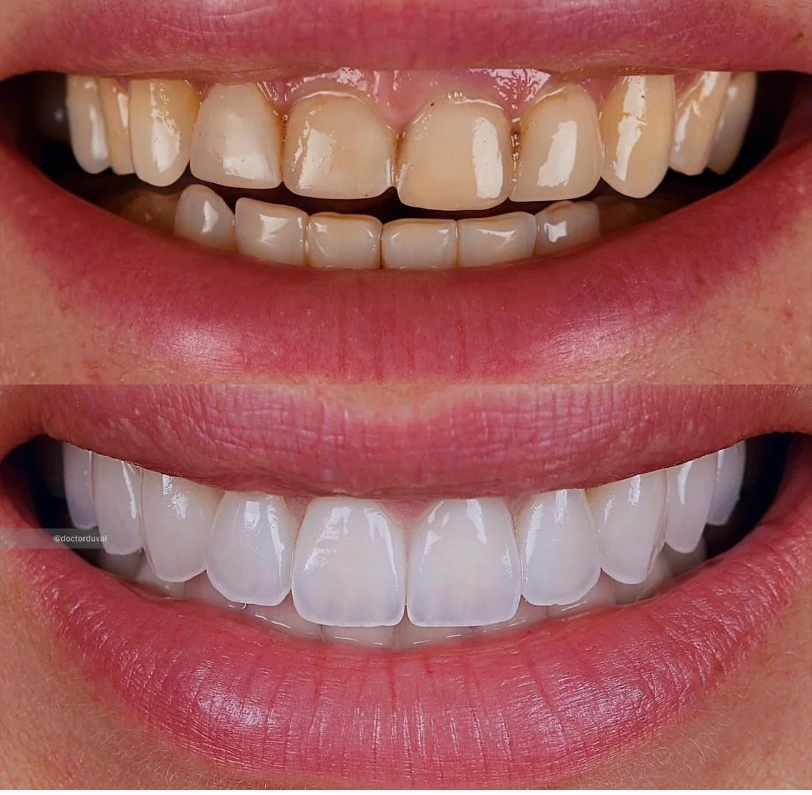 Full transformation: before treatment, old, discolored bonding and subtle gaps created an uneven appearance; after treatment, custom porcelain veneers seamlessly closed the spaces, restoring proper contouring and a vibrant, youthful vitality to the smile.